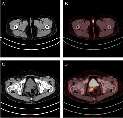 Case report: Synchronous tumors of the female reproductive tract in systemic lupus erythematosus: report of two cases and review of the literature